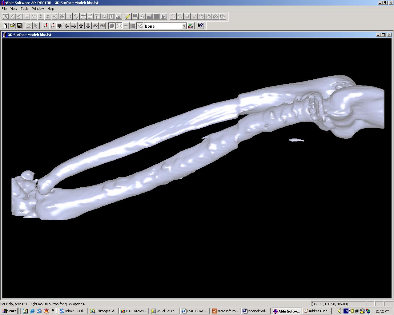 3D Model created from CT Image